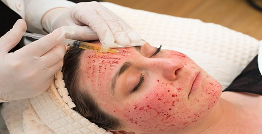 Vampire Facials